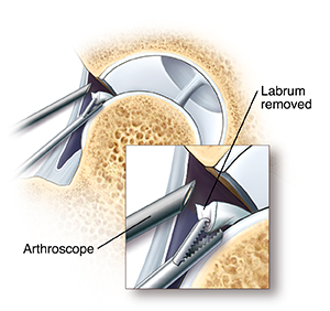 Cross section of hip joint showing arthroscopic instruments removing loose part of labrum. Closeup of arthroscope tip in hip joint and instrument removing part of labrum.