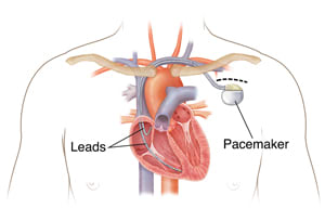 Outline of male chest showing pacemaker in chest with leads going into heart chambers.