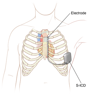 Front view of ribcage and heart showing an S-ICD placement in chest wall.. 
