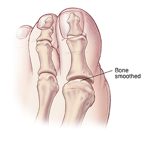 Top view of big toe showing joint after bone smoothed.