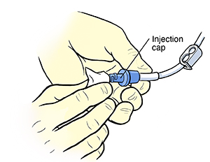 Gloved hands using alcohol wipe to clean injection cap of PICC line.