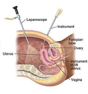 Cross section of female pelvis from the side showing laparoscopy.