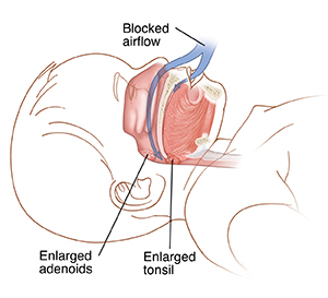 Side view cross-section of child's head showing enlarged adenoids and enlarged tonsil. Arrow shows enlarged adenoids and tonsils blocking airflow.