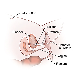 Cross section side view of female lower abdomen showing belly button, bladder, urethra, vagina, and rectum. Catheter is inserted through urethra into bladder. Balloon in bladder holds it in place.