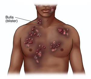 Front view of male head and chest showing bullous pemphigoid.