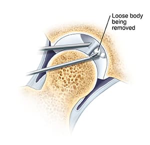 Cross section of hip joint showing arthroscopic instruments removing loose body from joint. 
