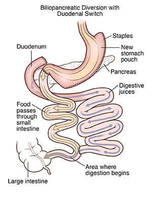 Biliopancreatic diversion with duodenal switch, showing stomach pouch and paths for food and digestive juices.