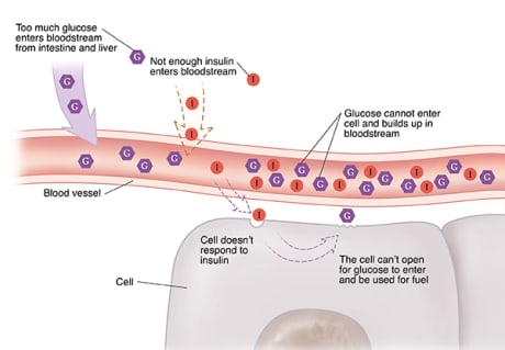 Closeup cross section of blood vessel near cells showing Type 2 diabetes. Cell doesn't respond to insulin. Glucose can't enter cells and builds up in bloodstream.