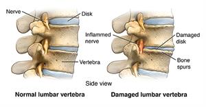  Detailed image of normal and damaged lumbar vertebrae.