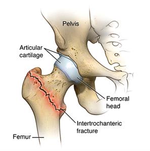 Hip joint and surrounding anatomy, showing intertrochanteric hip fracture below the hip joint.