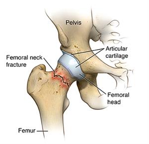 Hip joint and surrounding anatomy, showing femoral neck fracture just below hip joint.